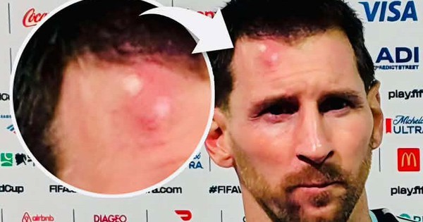 Messi sưng vêu trán sau trận thắng Cabo Verde: Vì sao nên nỗi? - hình ảnh - f168winn.com Messi sưng vêu trán sau trận thắng Cabo Verde: Vì sao nên nỗi? - hình ảnh - f168winn.com